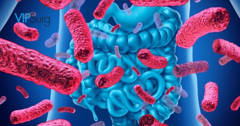 When to Use Probiotics With Weight Loss Surgery