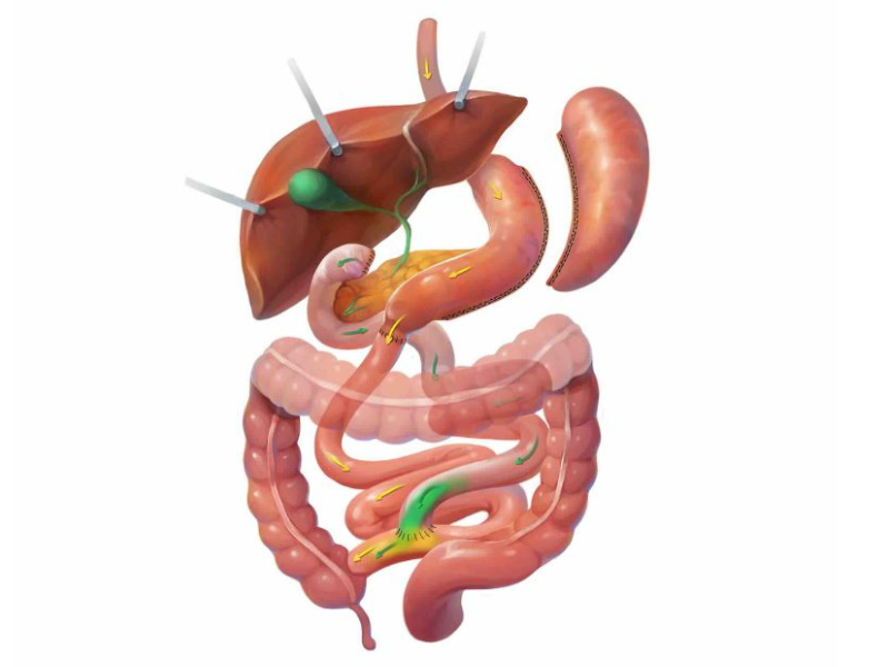 >How the Duodenal Switch Works