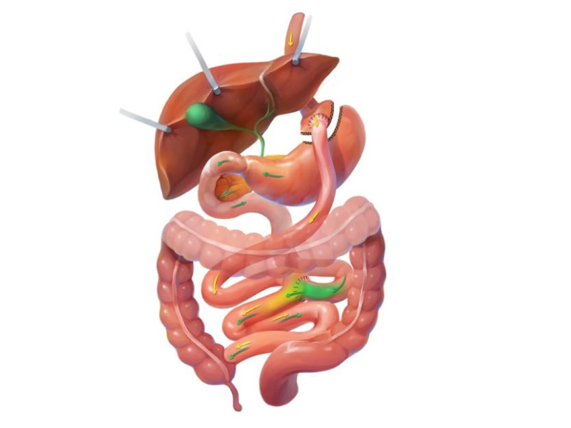 >Results of the Gastric Bypass